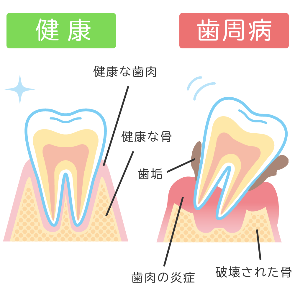 日本歯周病学会認定　歯周病専門医